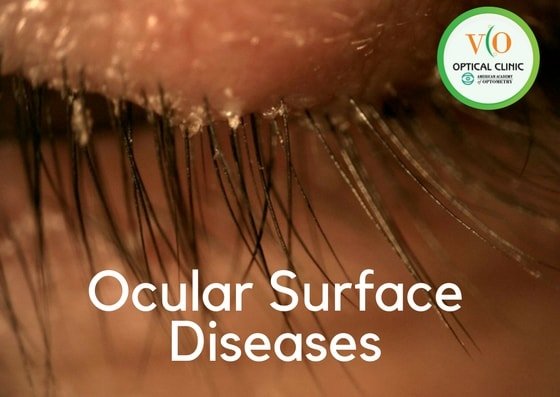 Ocular Surface Disease (OCD) / Penyakit Luar pada Mata