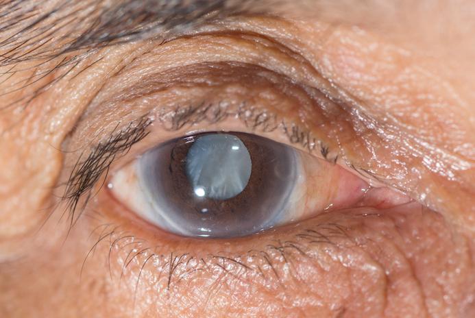 Glaukoma dan Kaitannya dengan Resiko Low Vision