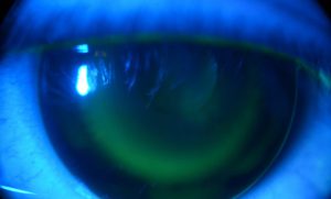 Mempelajari Manfaat yang Dihadirkan Orthokeratology untuk Kualitas Penglihatan