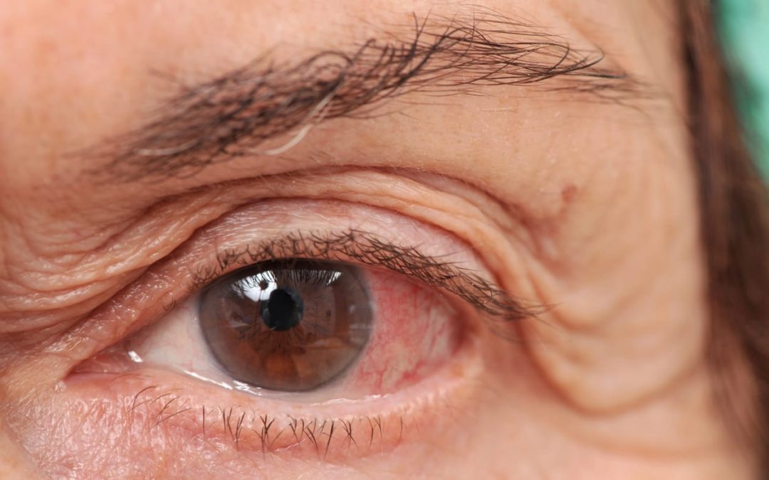 Pengaruh Retinopati Pada Masalah Low Vision