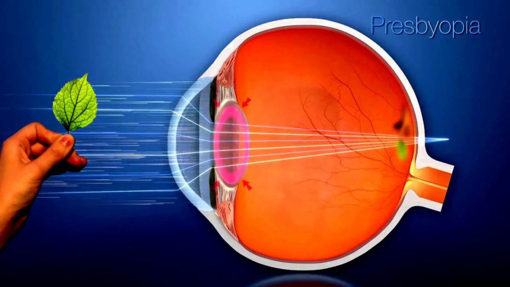 Orthokeratology dan Cara Kerjanya untuk Perbaiki Kelainan Refraksi