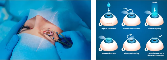 Lasik