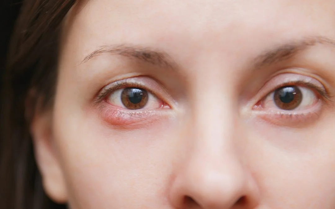 Waspadai Terjadinya Ablasi Retina Karena Mata Minus