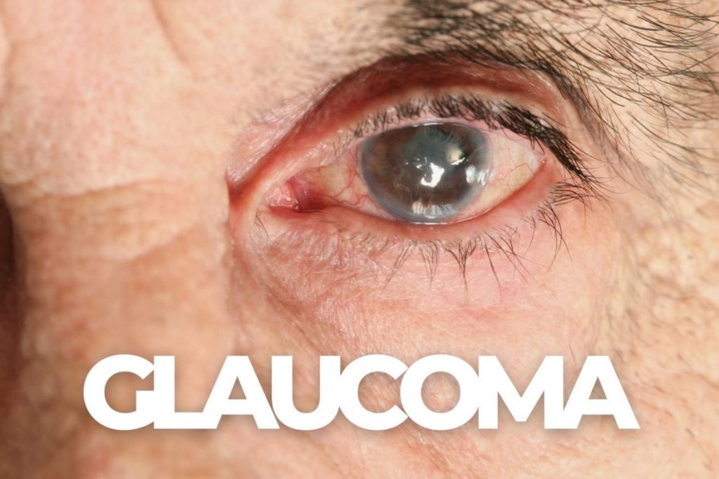 Glaucoma Salah Satu Gangguan Mata yang Perlu Diwaspadai