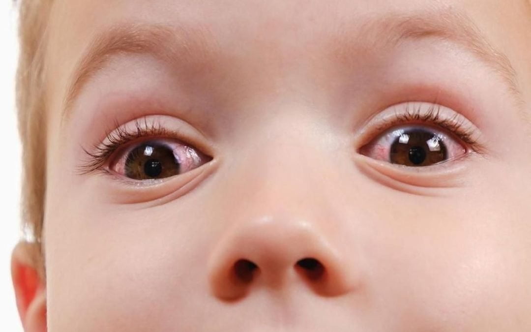 Cegah Gangguan Mata pada Anak dengan Tips Berikut