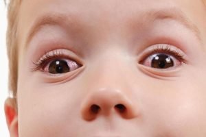 Pelajari tentang Gangguan Mata Merah pada Anak