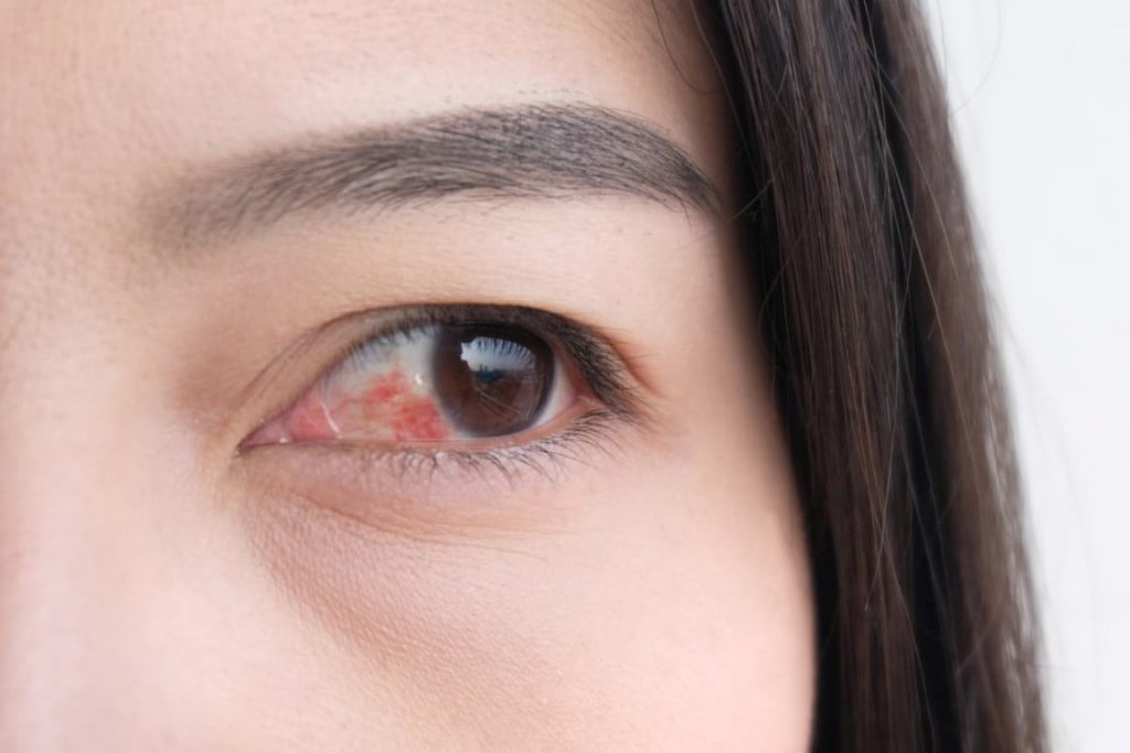 Konjungtivitis (Pink Eye): Penyebab, Gejala, dan Pengobatan yang Efektif