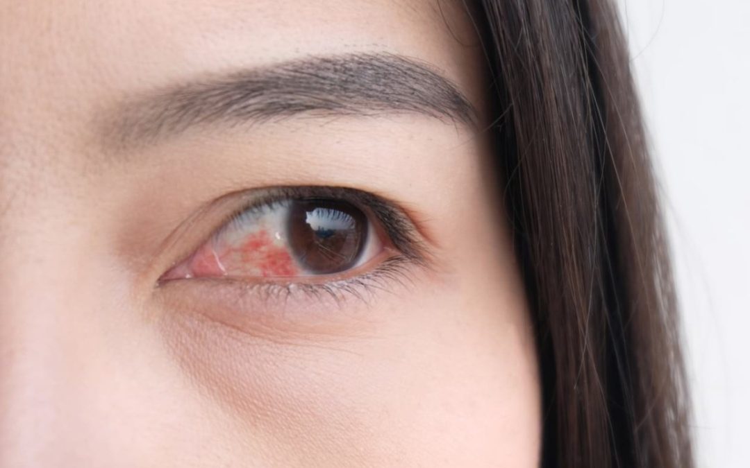 Konjungtivitis (Pink Eye): Penyebab, Gejala, dan Pengobatan yang Efektif