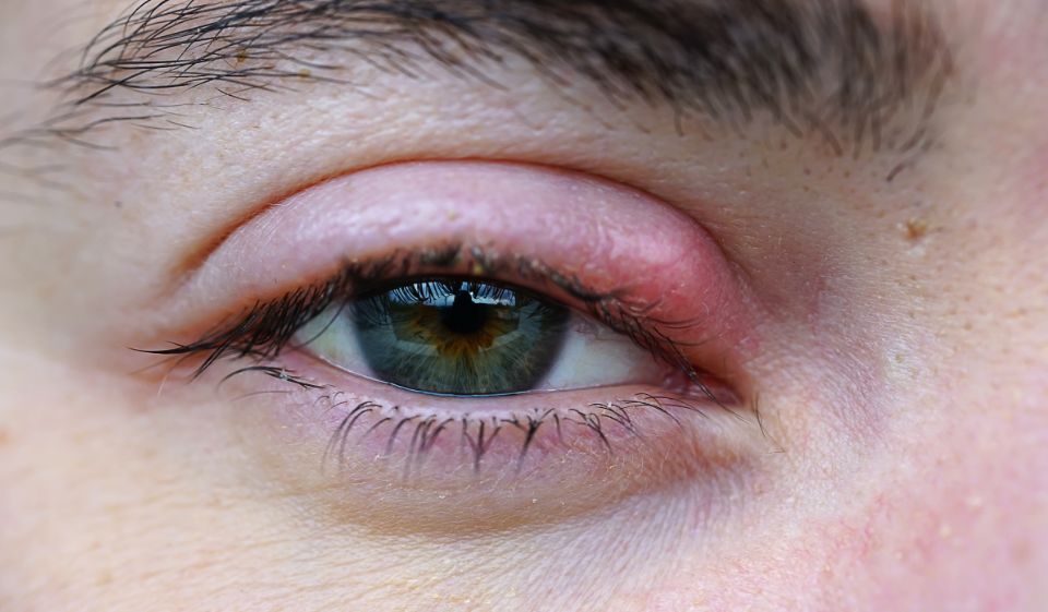 Mata Bintitan: Penyebab, Mitos yang Keliru, dan Cara Mengobatinya