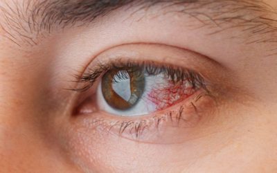 Mengenal Keratitis, Gangguan Penglihatan yang Harus Diwaspadai