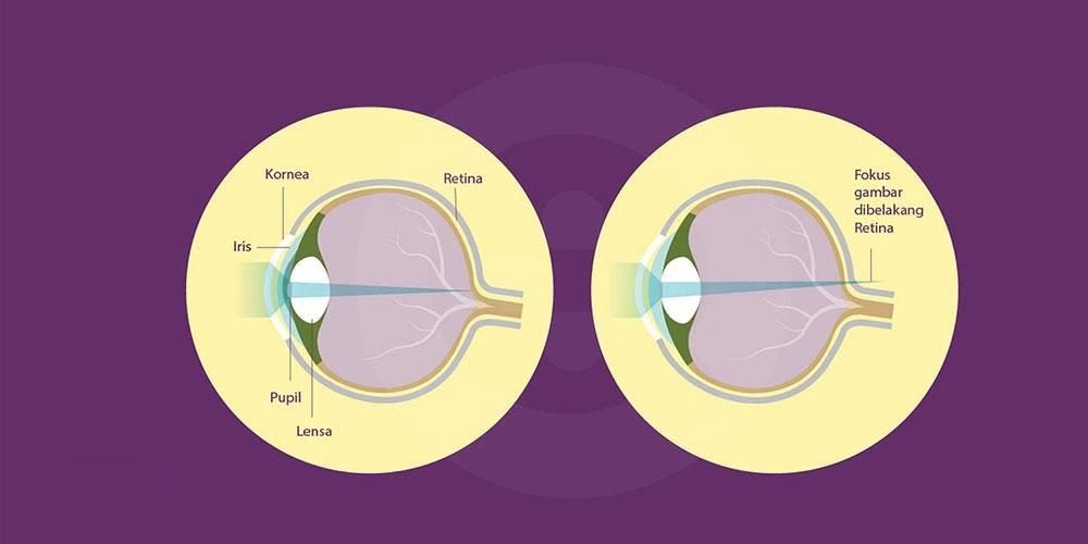 6 Upaya yang Bisa Dilakukan untuk Mencegah Rabun Dekat (Hipermetropi)