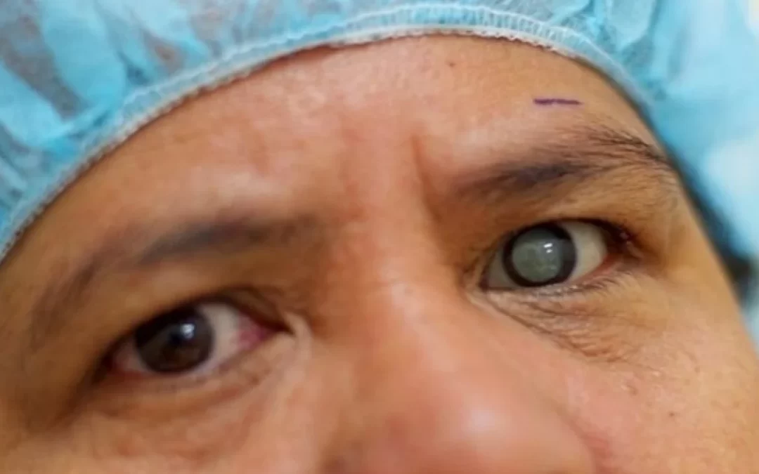 Risiko Mengalami Low Vision yang Semakin Besar Pasca Operasi Katarak?