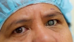 Risiko Mengalami Low Vision yang Semakin Besar Pasca Operasi Katarak?