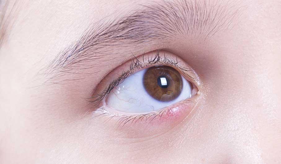 Langkah Efektif untuk Mengatasi Chalazion dengan Mudah