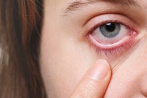 Retinoblastoma: Mengenal Kanker Mata yang Terjadi di Retina Mata