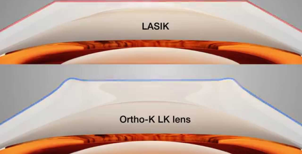 LASIK atau Ortho-K? Panduan Memilih Koreksi Penglihatan yang Sesuai dengan Kebutuhan Anda