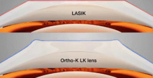 Sudah Pertimbangkan LASIK? Tunggu Dulu, Kenali Ortho-K Lebih Dulu!