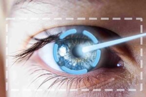 LASIK untuk Kornea Tipis: Risiko, Kelayakan, dan Alternatif yang Perlu Diketahui
