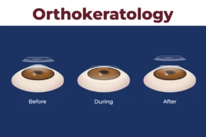 Penglihatan Bebas Repot dengan Ortho-K: Inovasi Tidur yang Mengubah Hidup
