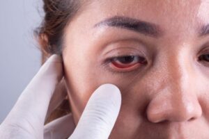 Bahaya Tidak Pakai Kacamata Minus! Risiko Mata Malas dan Kecelakaan