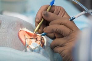 Penglihatan Setelah LASIK: Apakah Hasilnya Benar-Benar Permanen?