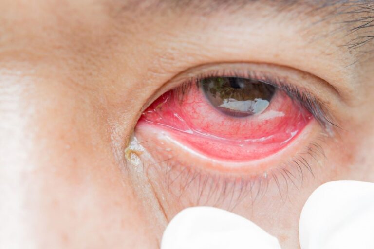 Jarang Disadari, Ternyata ini Tanda-Tanda Mata Anda Kurang Sehat!