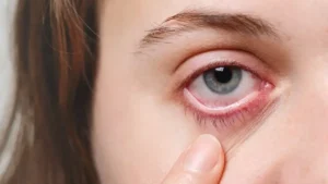 Mengenal Hipermetropi: Penyebab, Gejala, dan Pilihan Pengobatan Rabun Dekat