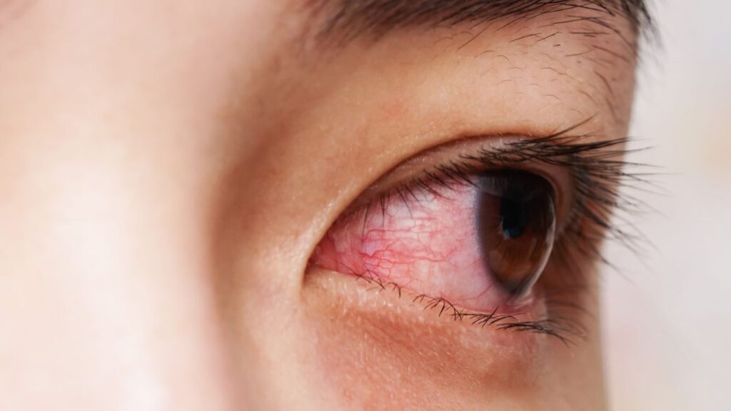 Pentingkah untuk Segera Membawa Anak ke Spesialis Mata jika Mengalami Mata Merah?