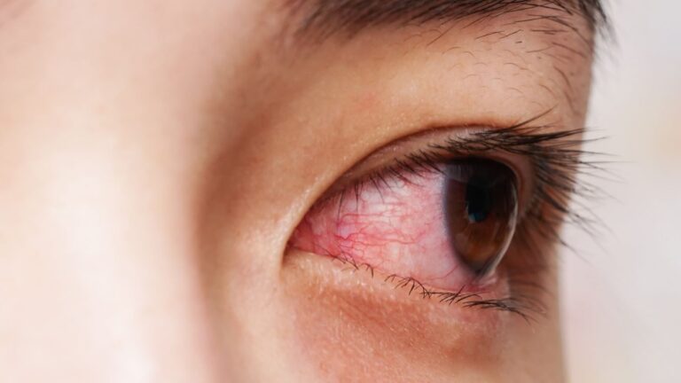 Pentingkah untuk Segera Membawa Anak ke Spesialis Mata jika Mengalami Mata Merah?