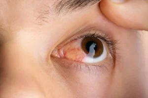 Apa itu Pterygium? Pertumbuhan Jaringan pada Mata yang Tidak Boleh Diabaikan