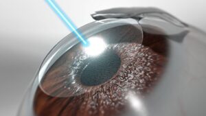 Jangan Sampai Menyesal Memutuskan LASIK! Kenali Keuntungan dan Kekurangannya