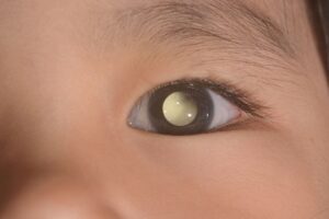 Mata Anak Terlihat seperti Mata Kucing saat Difoto? Waspadai Kanker Mata