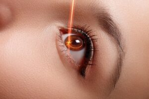 Minus Tinggi Sampai Belasan? Ini Alasan LASIK Belum Tentu Jadi Solusi Terbaik