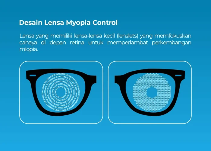 Desain-Lensa-Myopia-Control