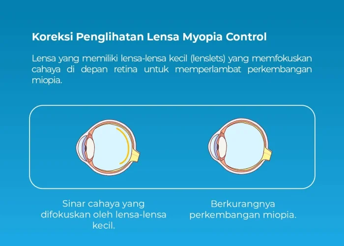 Koreksi-Penglihatan-Lensa-Myopia-Control
