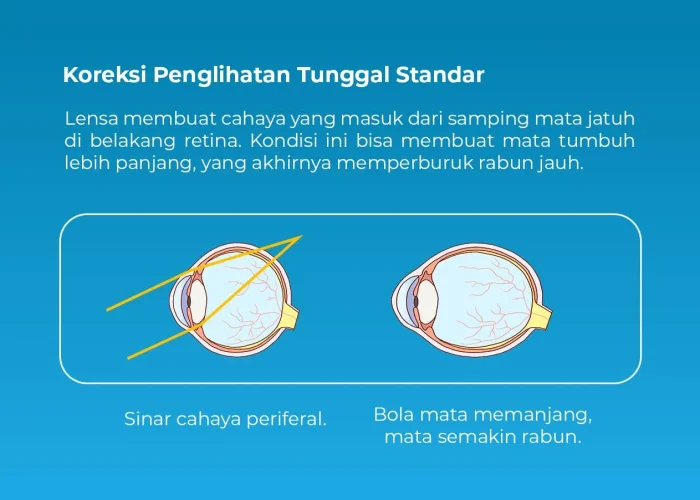 Koreksi-Penglihatan
