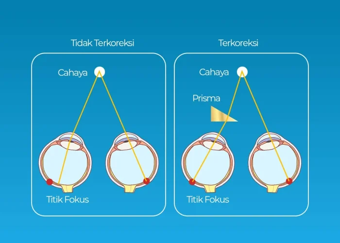 Prism-Lens